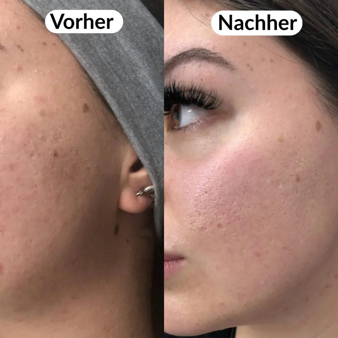 Peel Shot Koreanisch – Beseitigt Unreinheiten und verschönert Ihre Haut