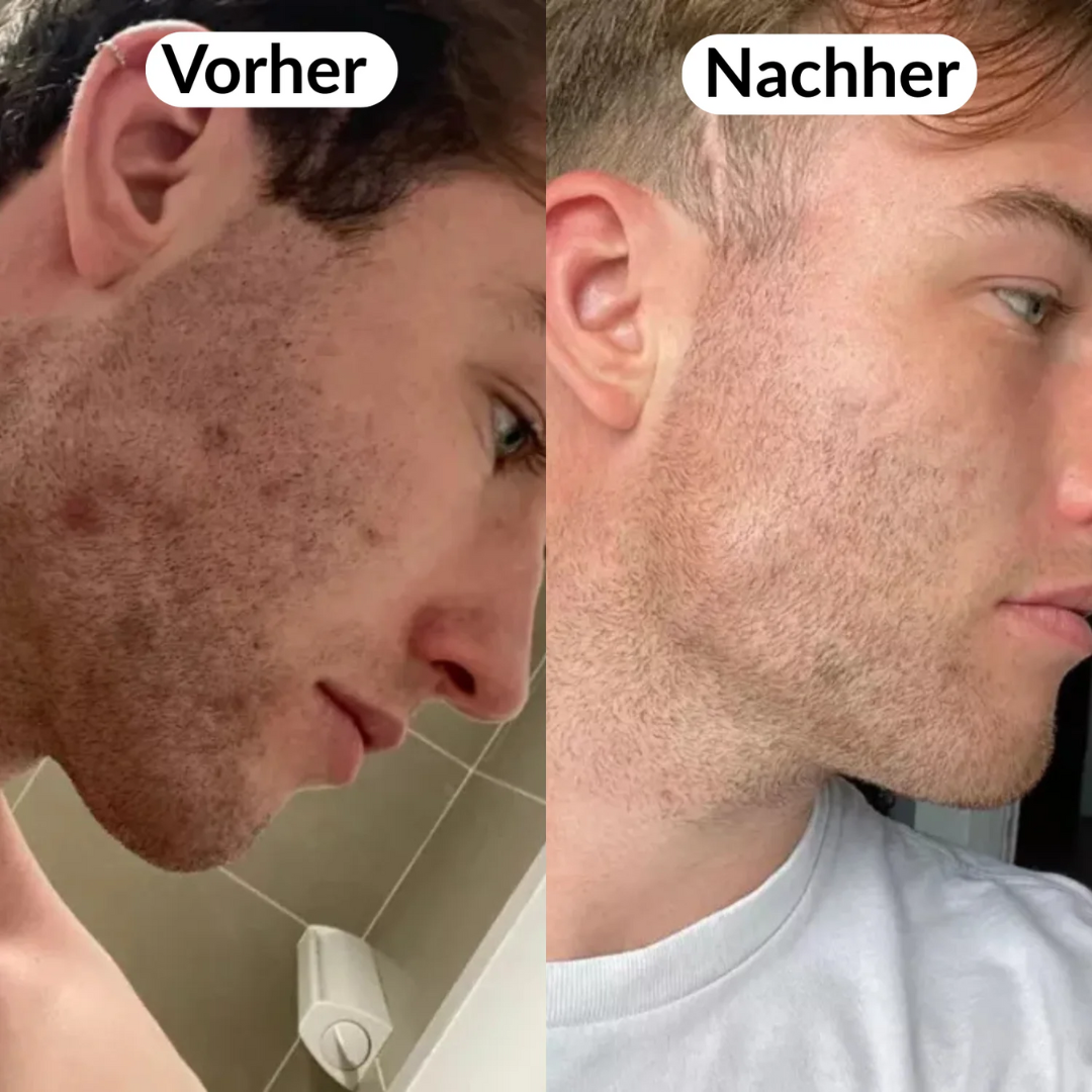 Peel Shot Koreanisch – Beseitigt Unreinheiten und verschönert Ihre Haut