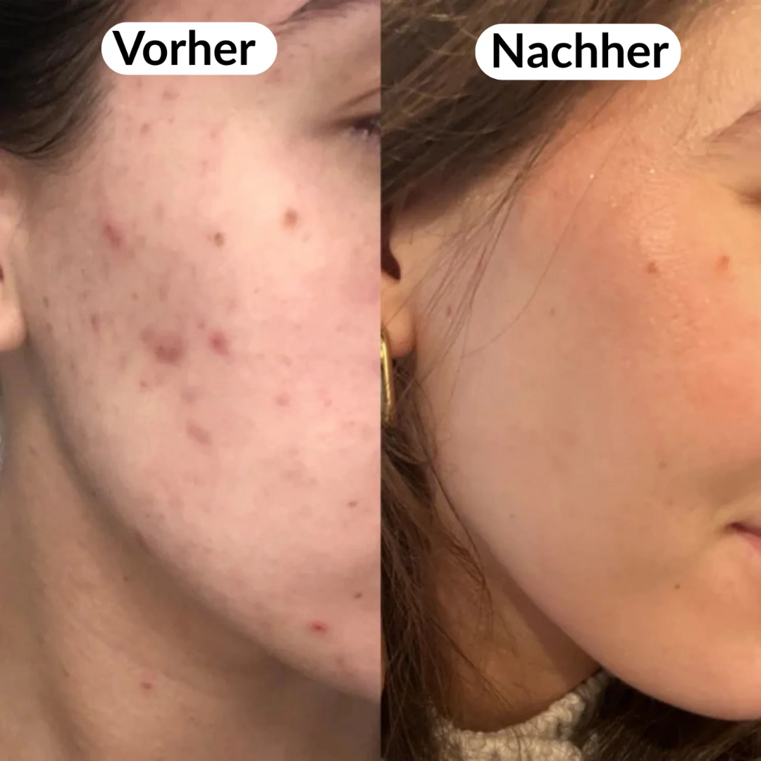 Peel Shot Koreanisch – Beseitigt Unreinheiten und verschönert Ihre Haut